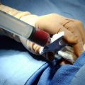 Stem Cell Transplant Procedure